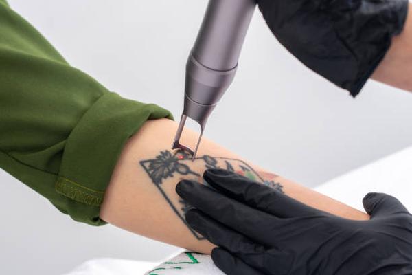 Affordable Laser Tattoo Removal Near Me